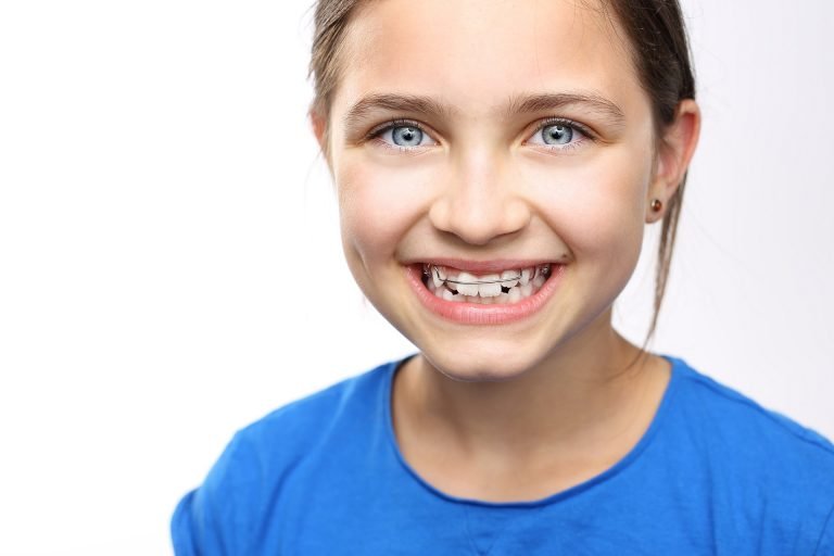 Can You Get Braces With Baby Teeth: Let’s Discover