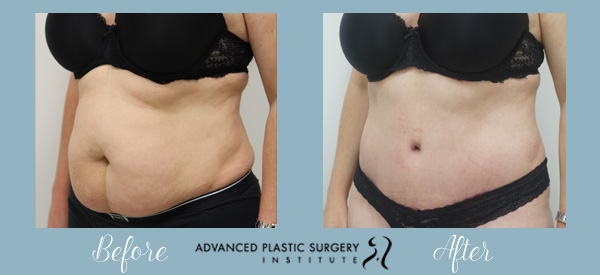 Read more about the article Can You Have a Baby After a Tummy Tuck